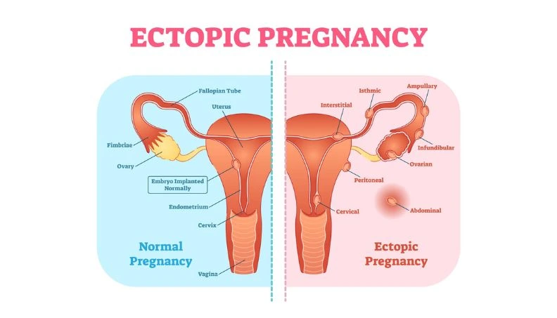 Ectopic Pregnancy