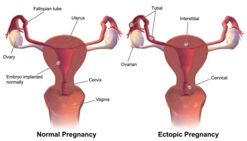 Ruptured Ectopic Pregnancy